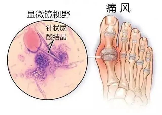 父亲节┃2022 夏季痛风准确治疗学术交流会在贵阳强直医院举办