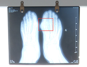 贵阳强直医院完满举办关爱风湿病康复援助公益活动