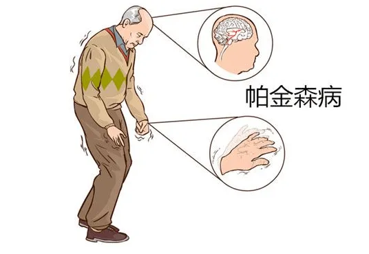 治疗帕金森哪家医院好：帕金森症是什么样的颤抖?