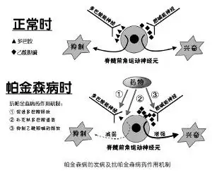 广州治疗帕金森哪家医院好：帕金森晚期症状有哪些？