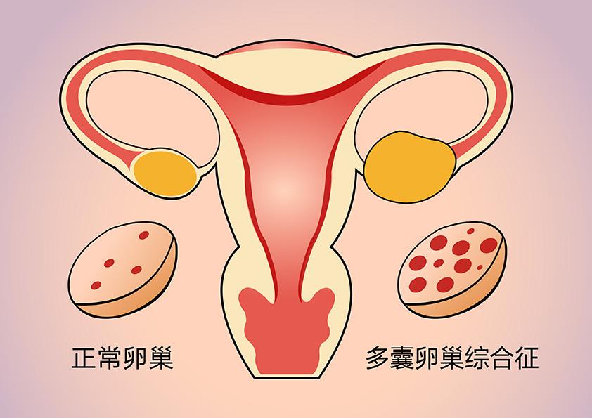 郑州不孕哪个医院好一点“公开发表”排行榜-多囊什么症状[前十口碑]