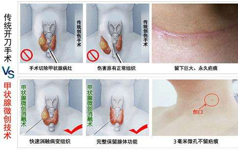 程肃敏主任：甲状腺结节多大需要手术？