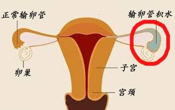 郑州不孕医院口碑-治多囊，省钱又有效的方法有哪一些？