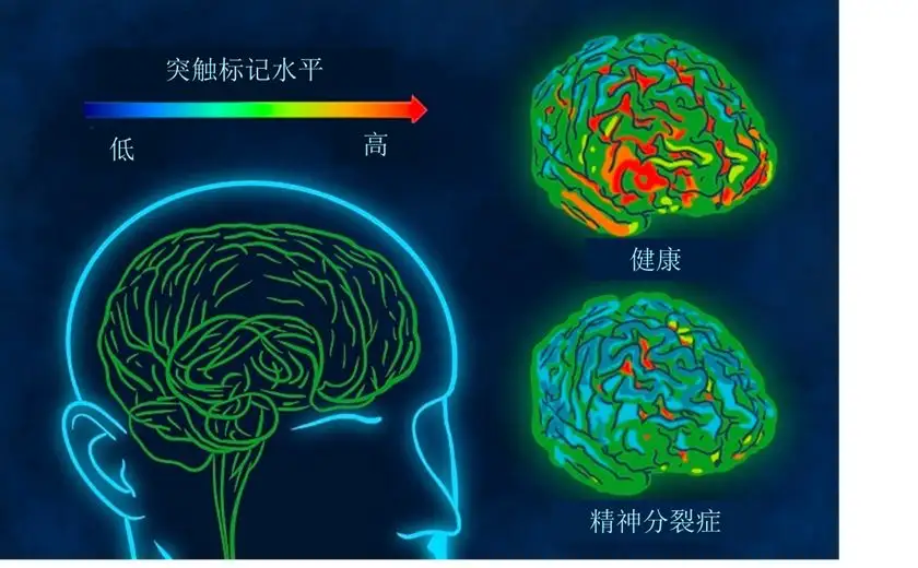 南宁专治精神疾病医院：间歇性精神病怎么护理？