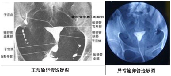 河南治疗输卵管堵塞的医院排名-郑州治输卵管堵塞需要花多少钱