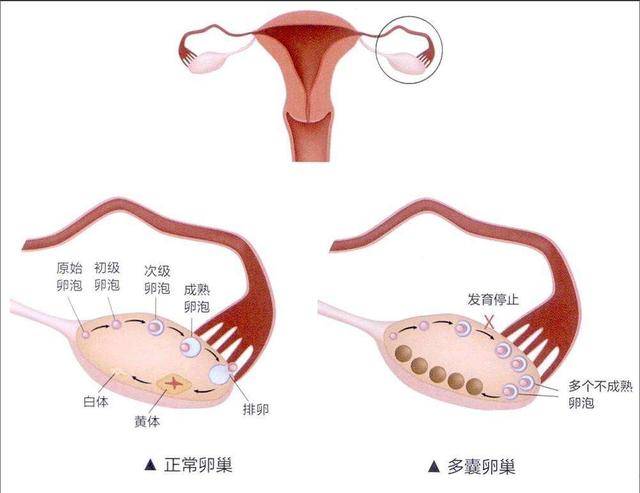 多囊卵巢不生孩子，可以不治疗吗【郑州不孕医院】