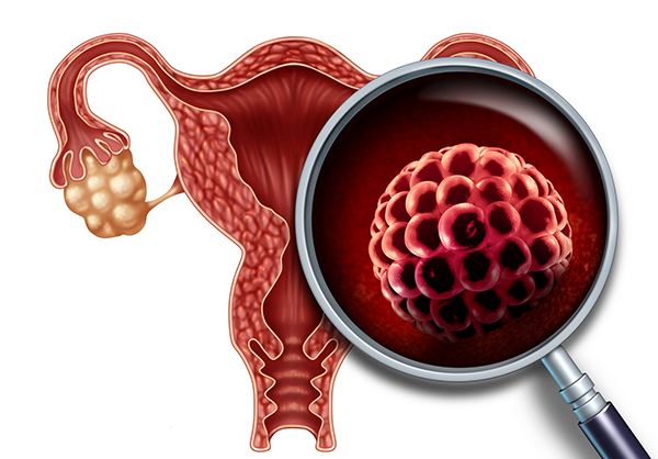 多囊卵巢综合症较关键的治疗是什么？