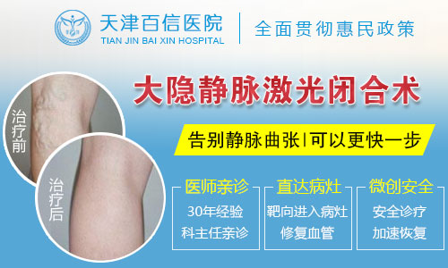 天津有下肢静脉曲张要怎么办