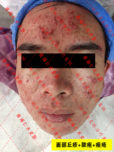 为什么过了青春期还长痘痘，应该怎么治疗