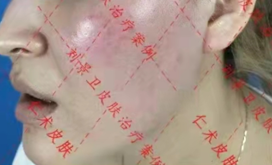 海口皮肤病医院哪家好?激素性皮炎怎么治疗?