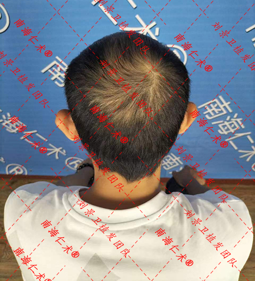 海口脱发去哪治疗？为什么会脱发？有什么办法可以治疗脱发？