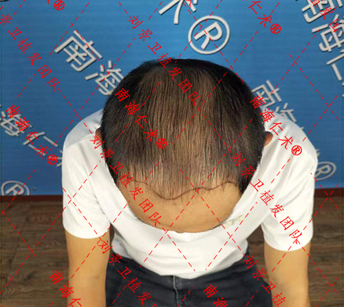 年轻人脱发要注意这几件事！日常如何预防脱发？