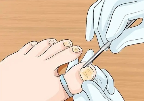 海口皮肤病医院哪家好？得了灰指甲，是不是拔掉就好了？