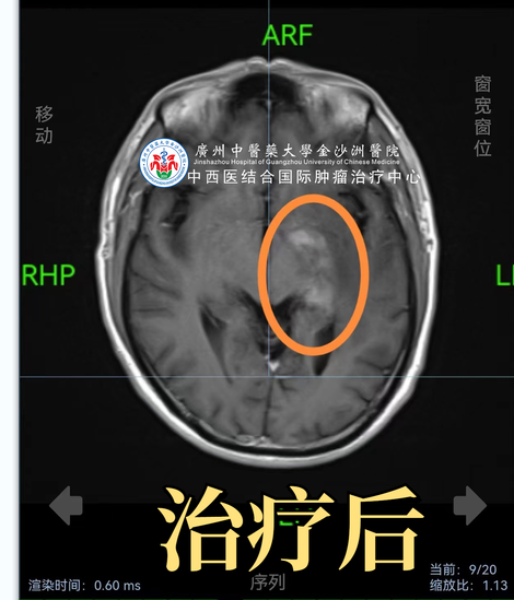 做了治疗后发现是误诊？幸遇良医终康复！