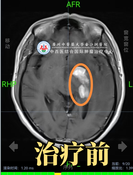 做了治疗后发现是误诊？幸遇良医终康复！