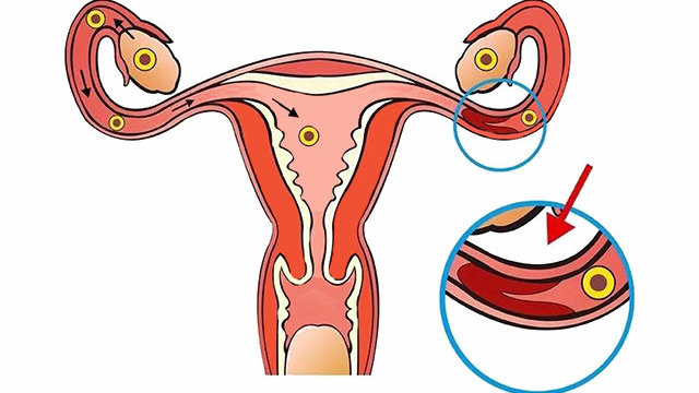 【河南不孕不育医院在哪】多囊卵巢卵泡排卵障碍怎么治疗