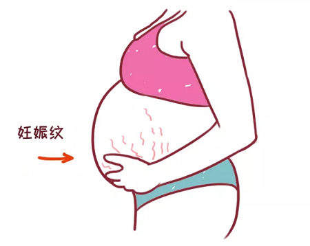 宝妈们，海南皮肤科医院治疗妊娠纹可以的！
