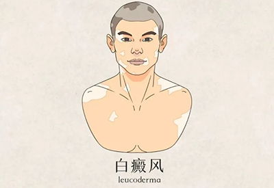 海口白癜风医院-白癜风真的就那么难治吗？