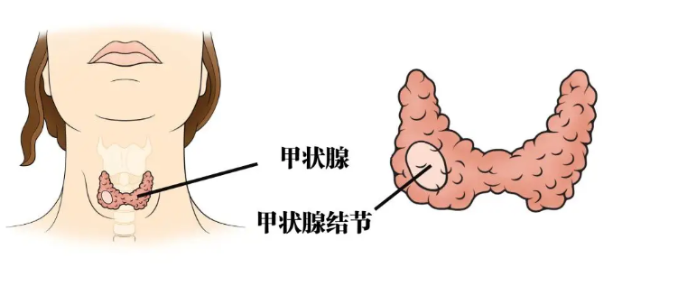 为什么女性大都有甲状腺结节？为何甲状腺结节“偏爱”女性？