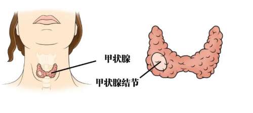 为什么女性大都有甲状腺结节为何甲状腺结节“偏爱”女性