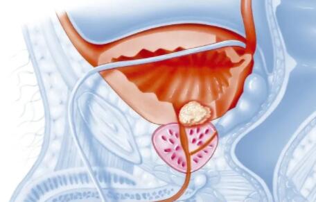 前列腺切除还能过吗?会有哪些并发症