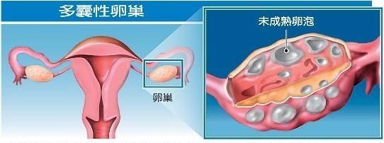 2023排名：郑州治疗多囊卵巢蕞好医院(专业榜)，引起多囊的原因有哪些