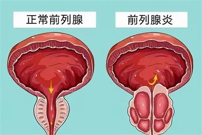 “男”言之隐——慢性前列腺炎，中医辨证论治的特色！