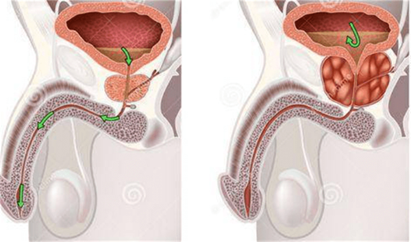 前列腺疾病怎么治？搞清楚这三点，方向就找对了！