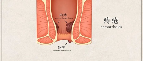 北京治疗痔疮哪家医院好？内痔自测，看看自己是哪一期？