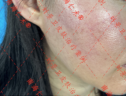 海口皮肤医院治疗激素皮炎恢复期是多久？仁术皮肤科在哪里？