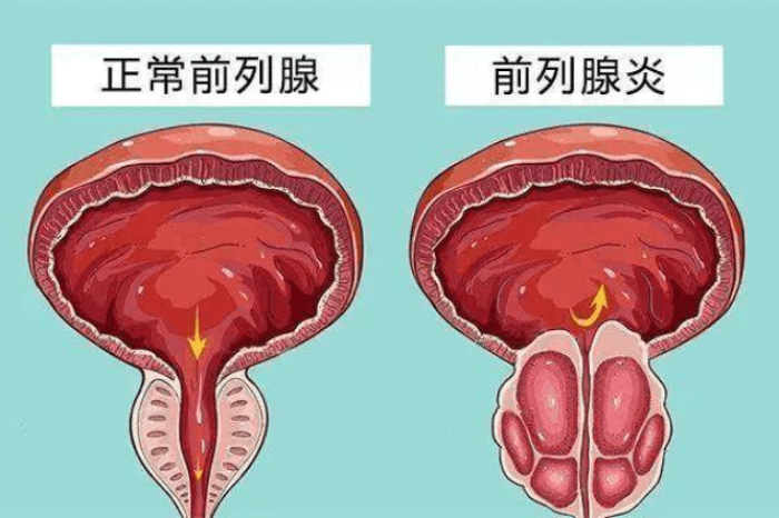 前列腺炎有什么症状？吃什么药治疗比较好？