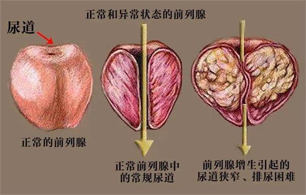 尿频、尿急、尿不尽、尿等待，前列腺增生问题到底该如何解决？