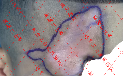 白癜风患者“二阳”了会对白癜风有什么影响？海口白癜风医院在哪里？