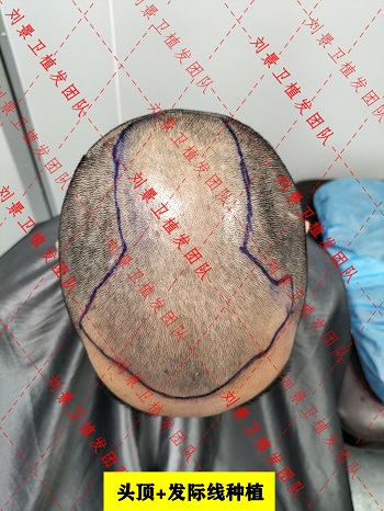 热点分享：如何定义海南正规植发医院价格的高低？