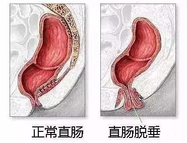 北京丰益医院是几级医院？直肠脱垂VS内痔脱出？明确病情后科学治疗！