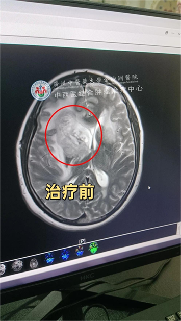 分享：广州金沙洲医院肿瘤医生马晓东使用m6射波刀治好脑胶质瘤患者成功案例