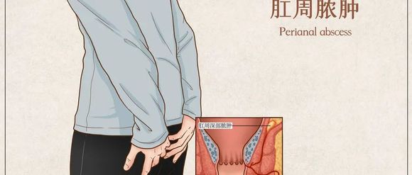 北京丰益肛肠医院怎么样？肛周脓肿发生有什么症状？