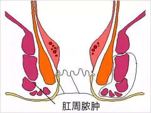 肛瘘找上门？看看自己犯了什么错