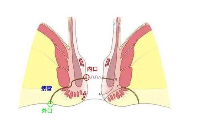 肛瘘找上门？看看自己犯了什么错