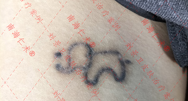 海口仁术皮肤洗纹身.jpg