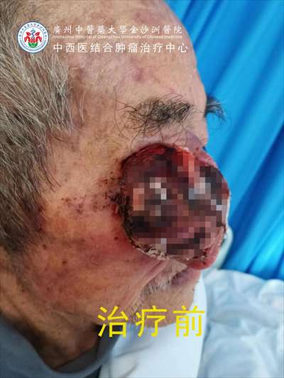 马晓东医生瓦里安直线加速器治愈右眼睑恶性黑色素瘤成功案例 黑色素瘤能治好吗