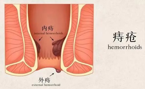 北京痔疮医院排名 痔疮术后出现假性愈合是怎么回事？ 