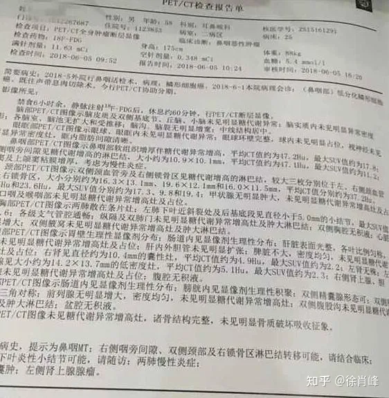 m6射波刀鼻咽癌早期症状成功案例,鼻咽癌治愈率医生马晓东医生在线预约挂号咨询(图2)