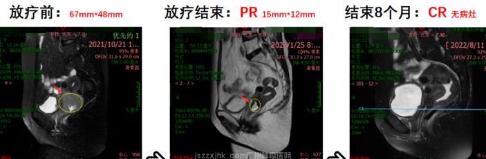 宫颈癌成功案例20230716094518864.jpg