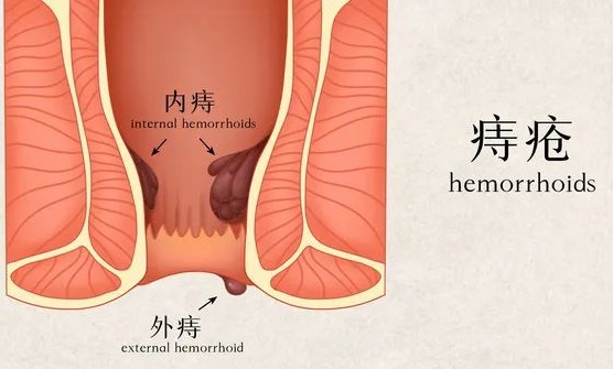 北京痔疮医院 你的痔疮是怎么“养”的？你知道吗？