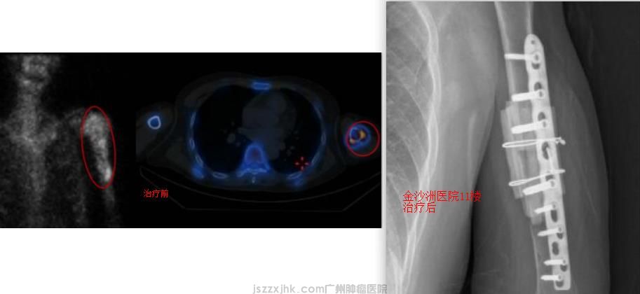 软骨肉瘤成功案例对比图.jpg