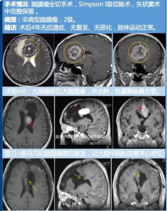 金沙洲医院11楼伽马刀脑膜瘤成功案例前后图片.jpg