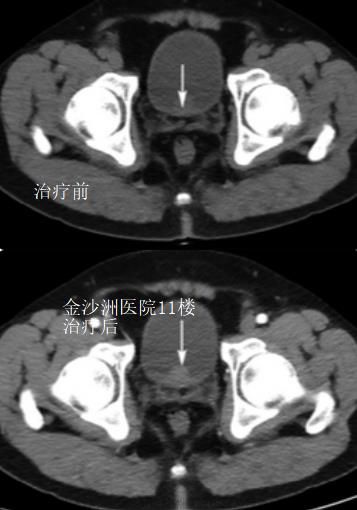 膀胱癌治疗成功案例对比图.jpg