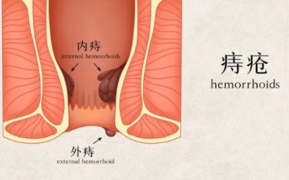 北京痔疮医院哪家好？为什么痔疮会导致贫血？