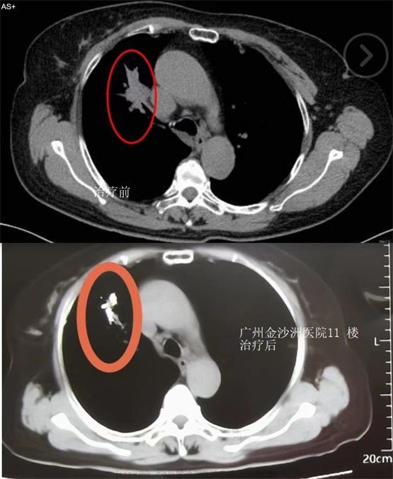 肺癌成功案例对比图.jpg